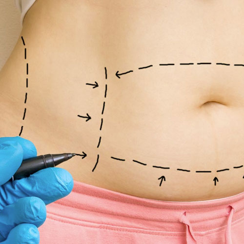 abdominoplastia