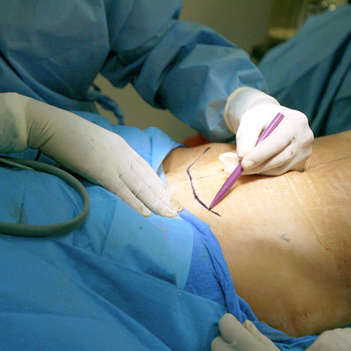 voirol-abdominoplastia-2 abdominoplastia