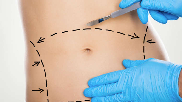 Abdominoplastía