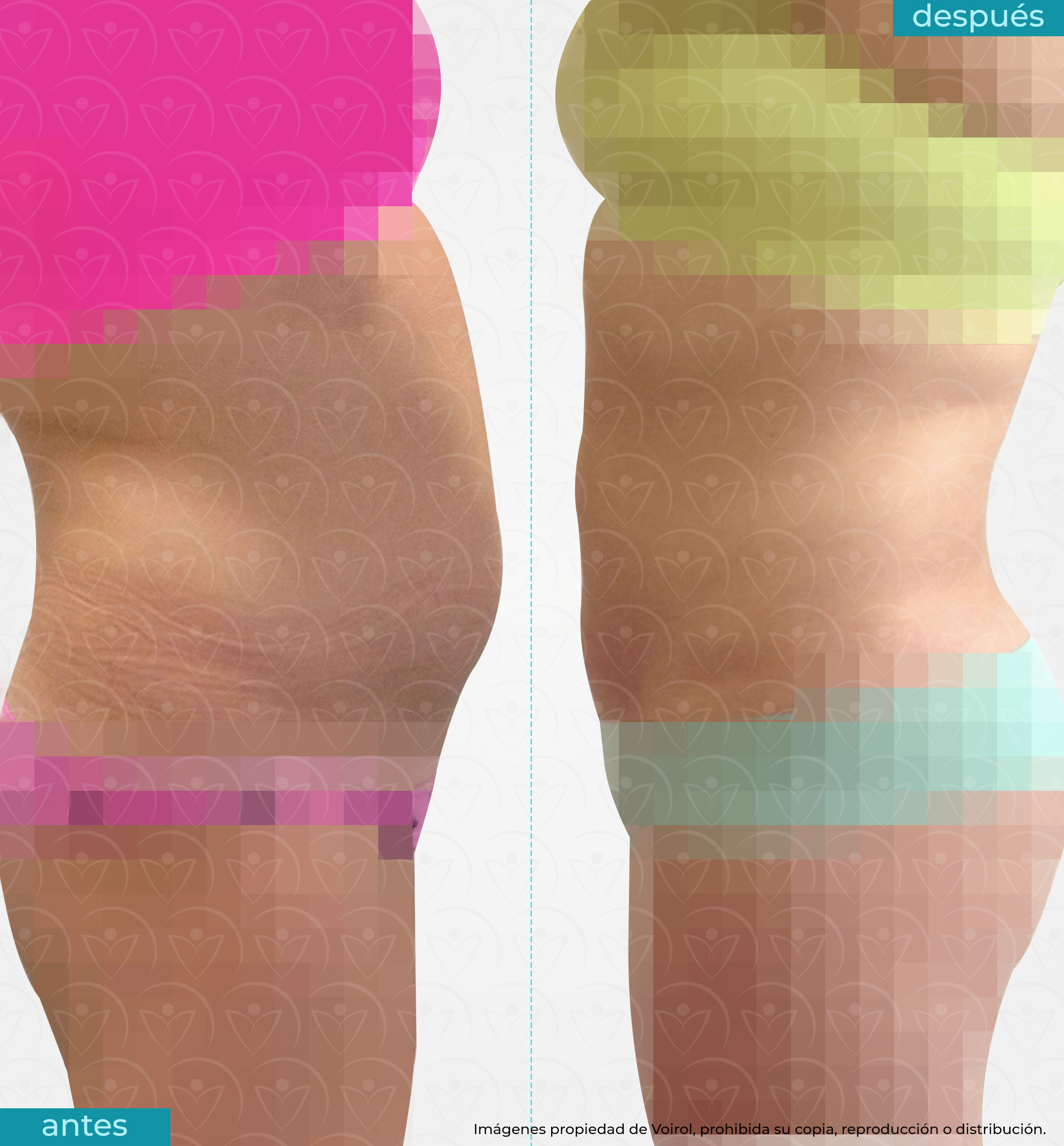 antes y después de lipoescultura