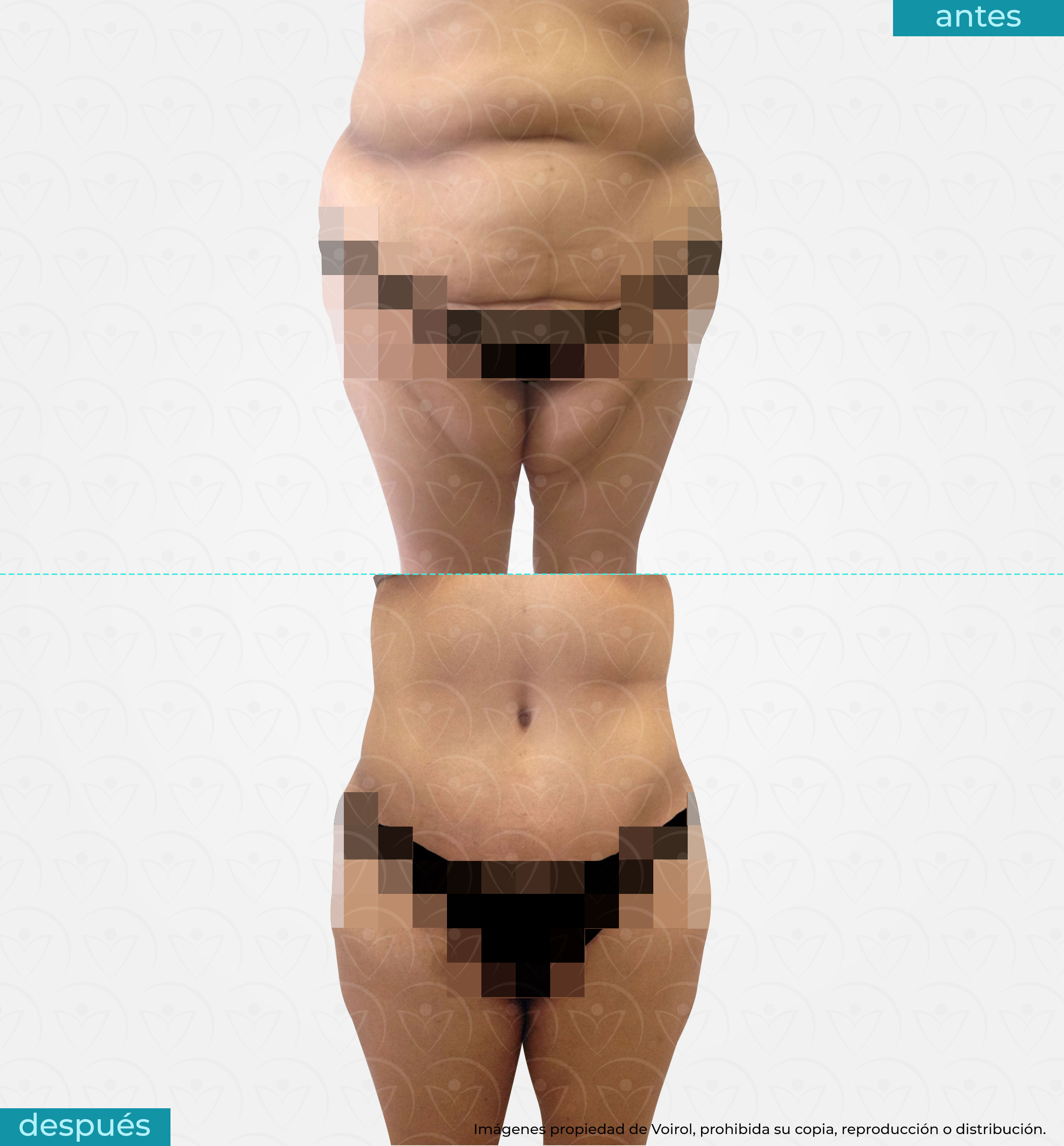 antes y después abdominoplastía