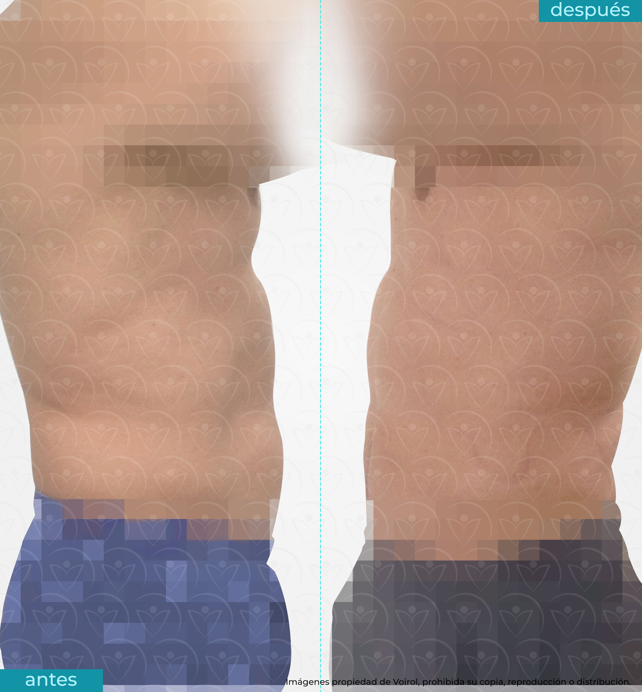 antes y después lipoescultura