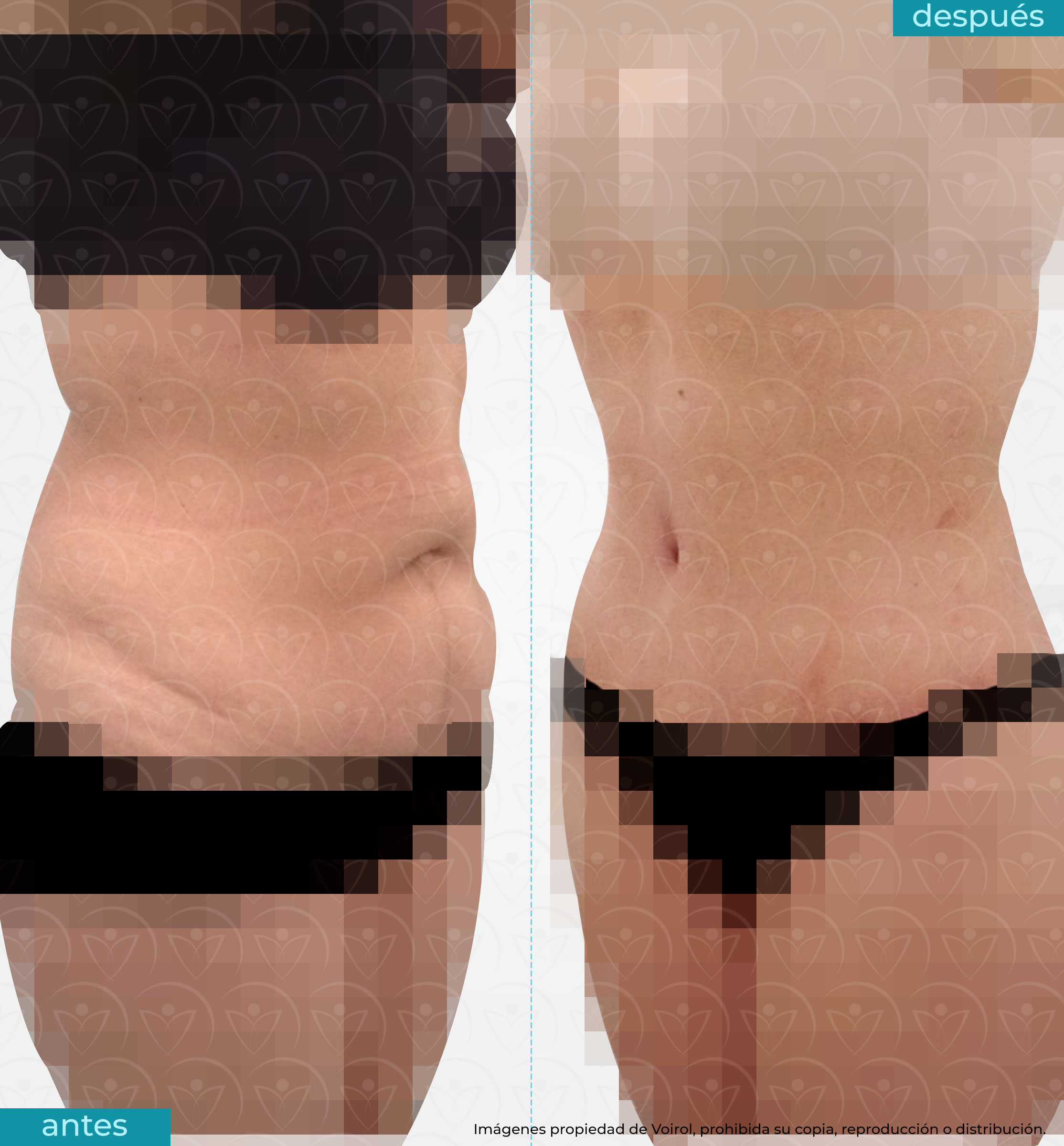 antes y después abdominoplastía