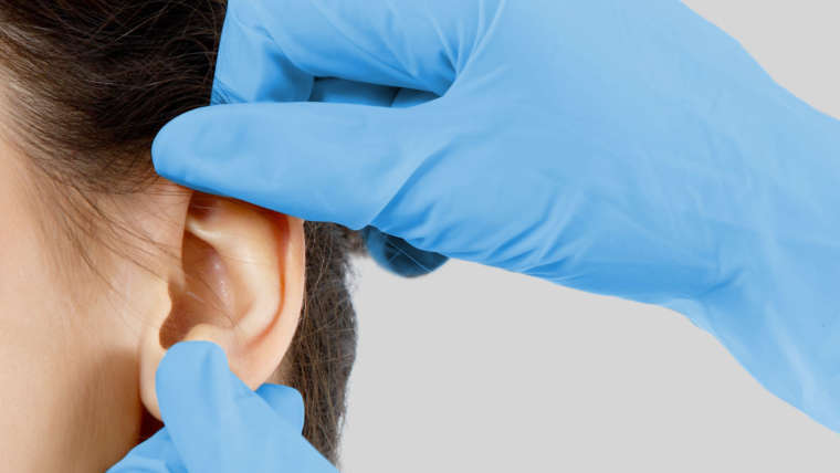 Otoplastía