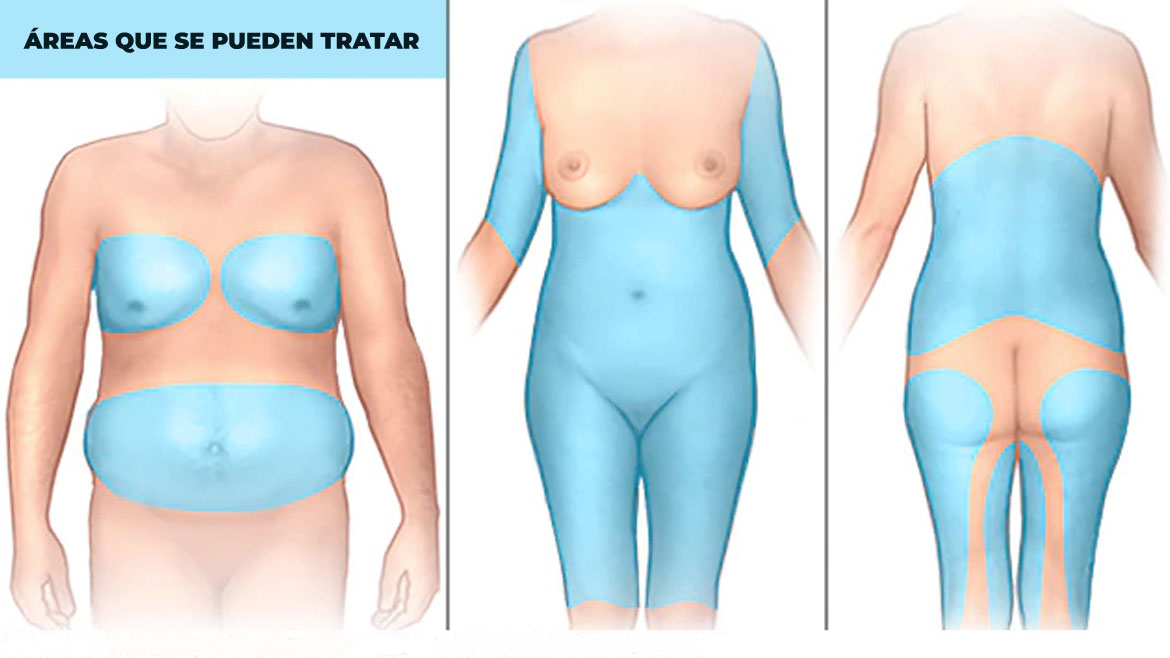 areas-a-tratar-liposuccion zonas a tratar liposucción