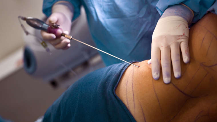 Liposucción & Lipoescultura