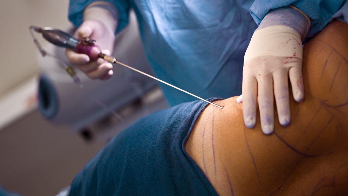 Liposucción & Lipoescultura