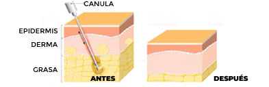 liposuccion-proceso proceso de la liposucción