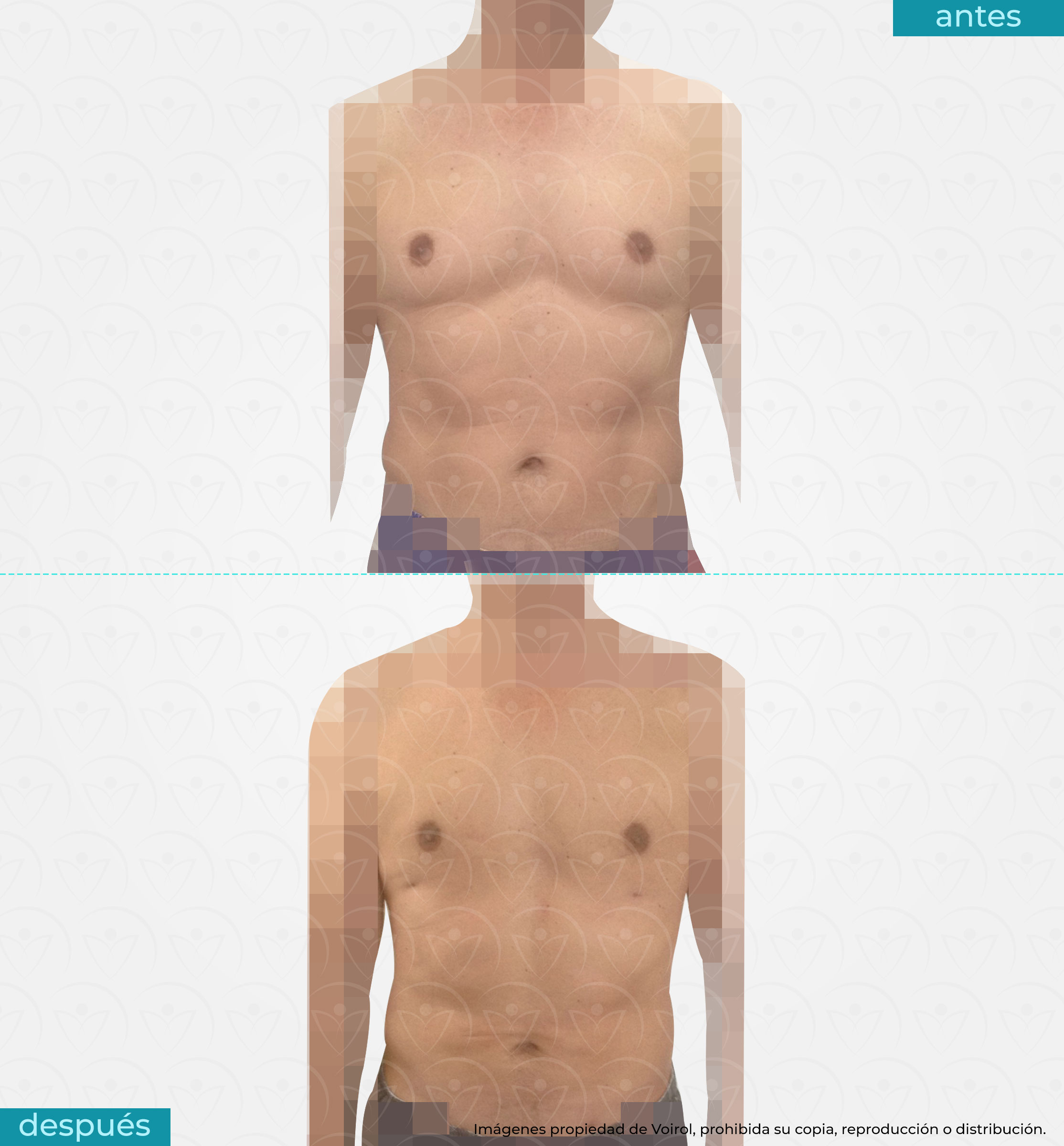 antes y después de lipoescultura