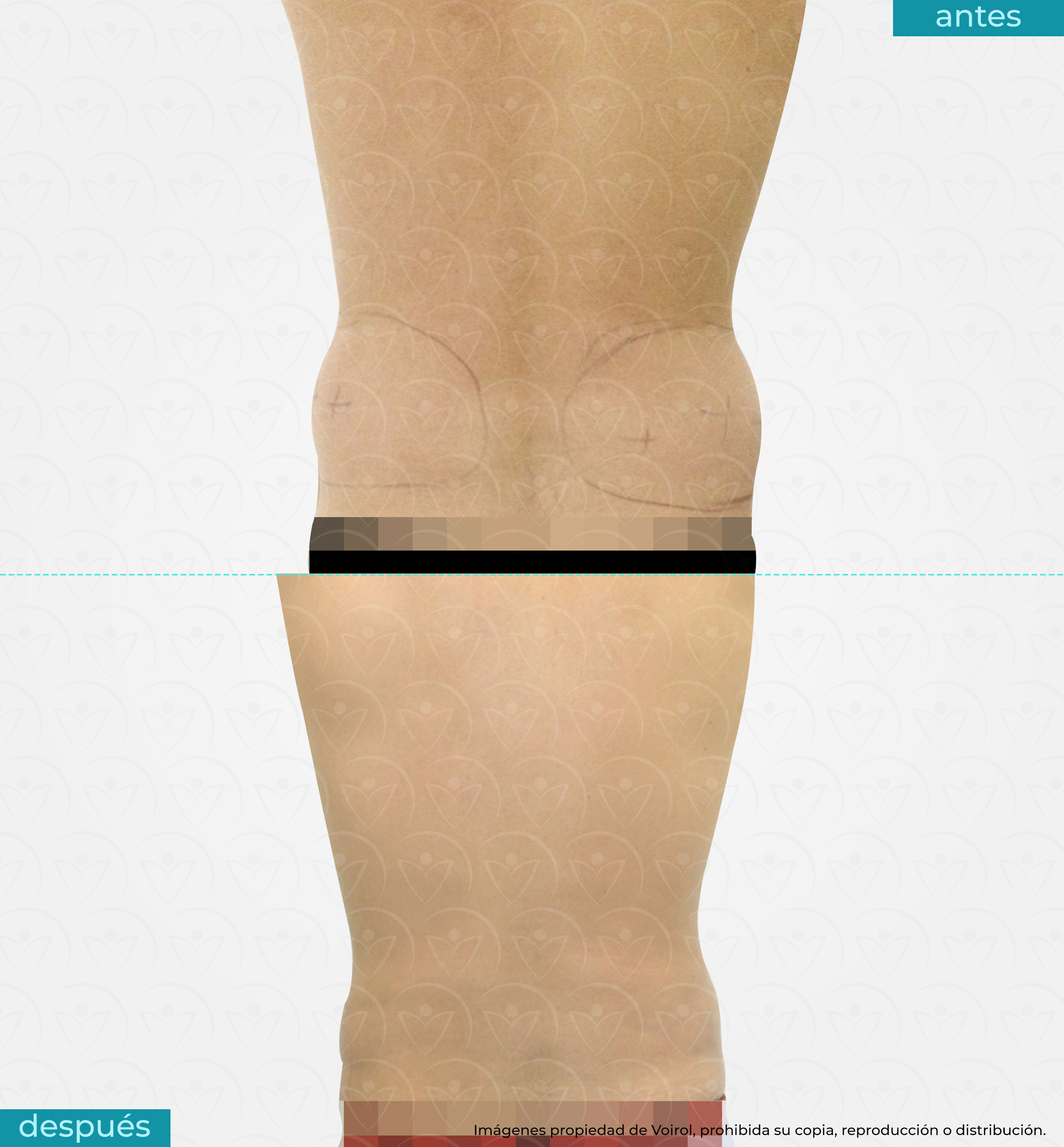 antes y después de lipoescultura