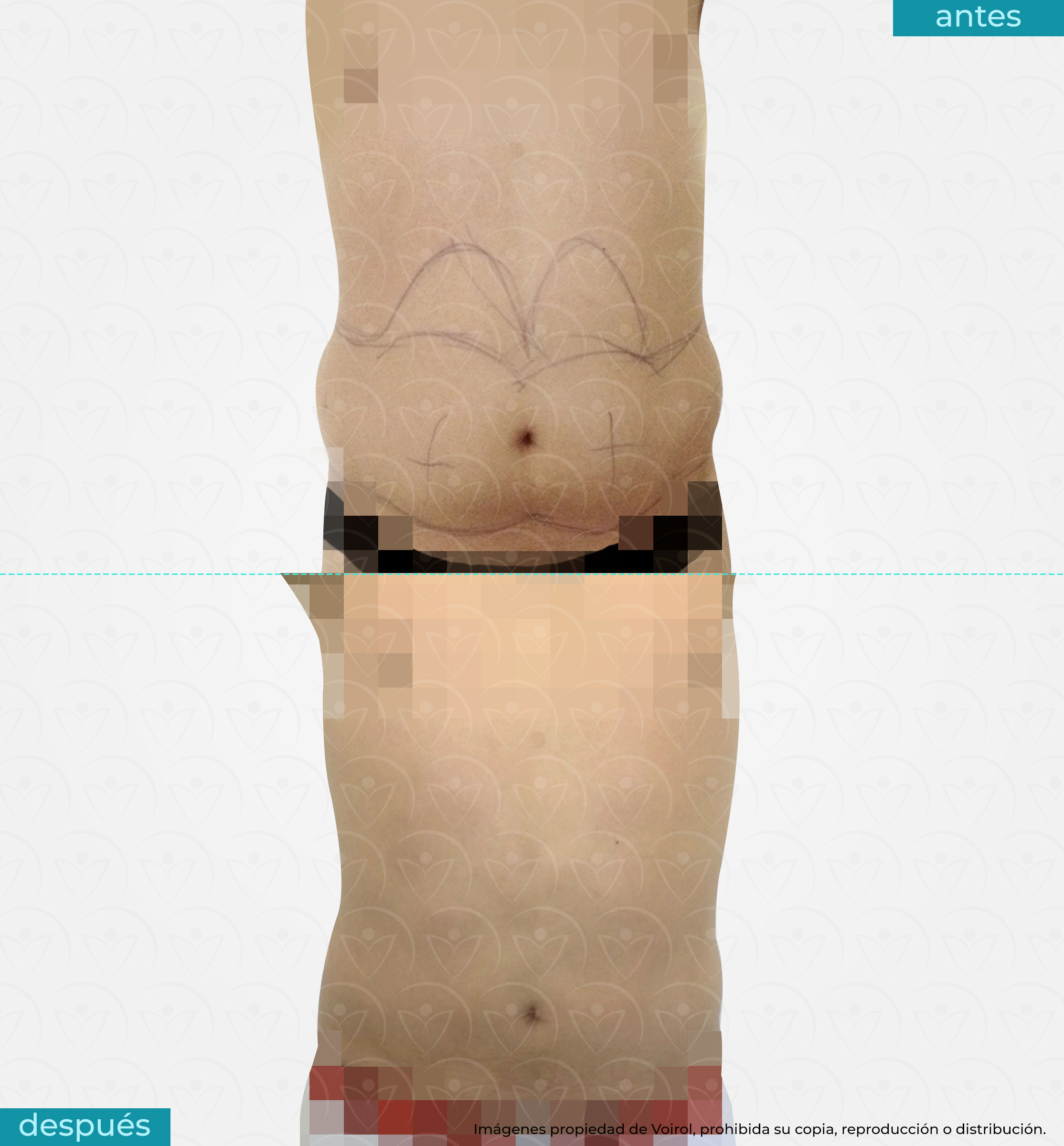antes y después de lipoescultura