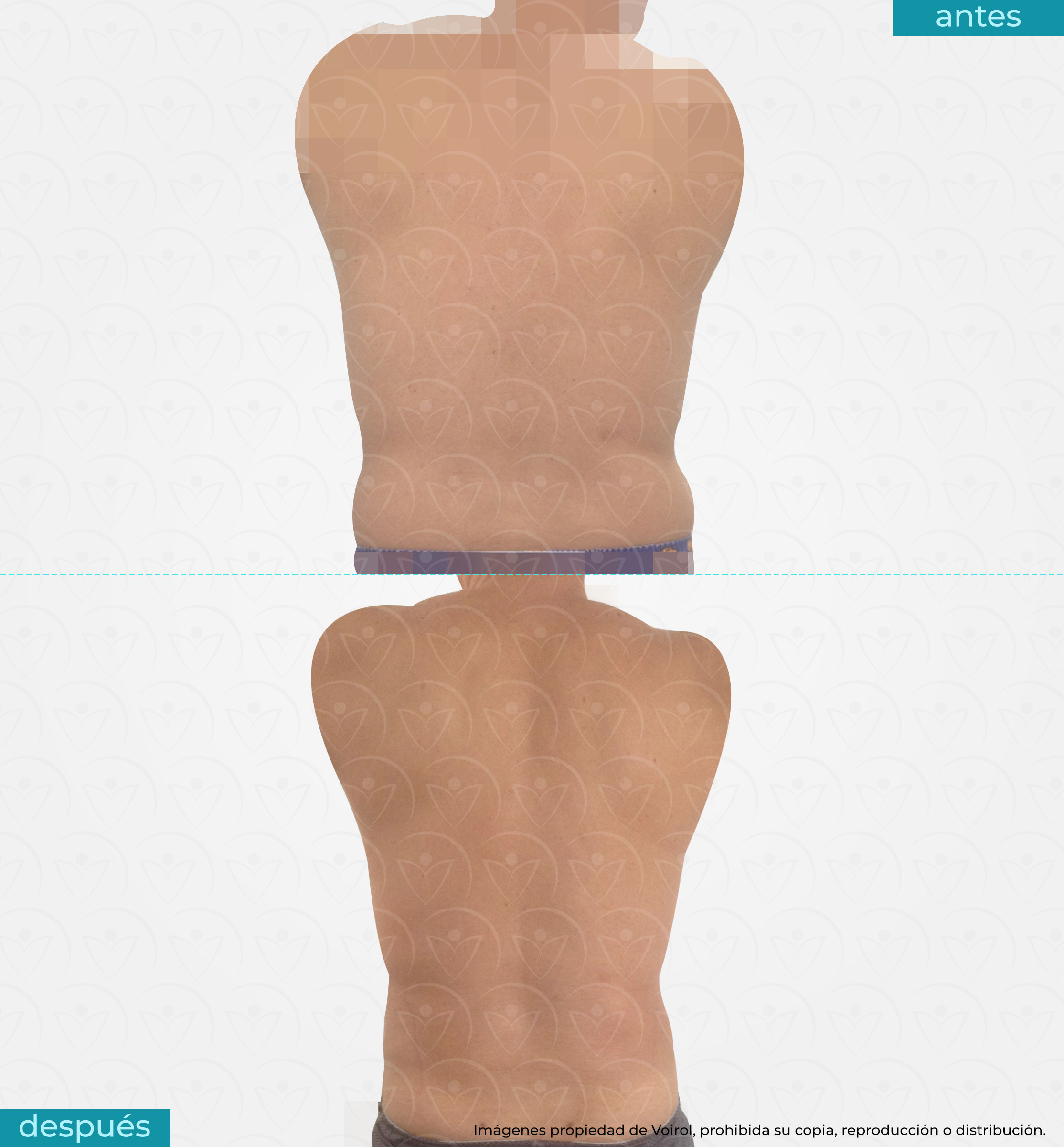 antes y después de lipoescultura