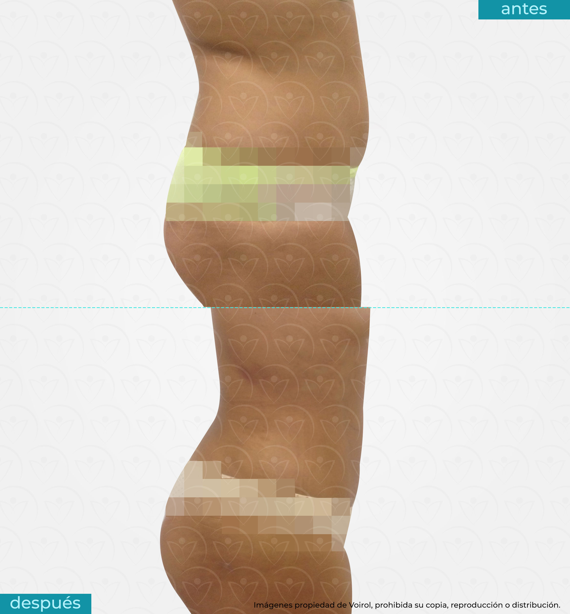 antes y después de lipoescultura