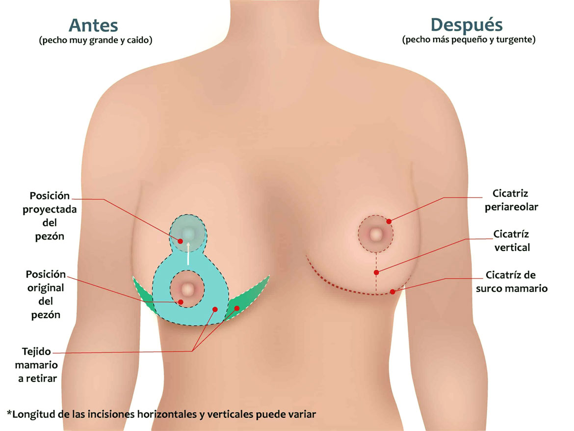 voirol-incision-reduccion-de-senosA reducción de senos