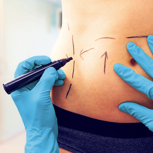 voirol-liposuccion-1 liposucción