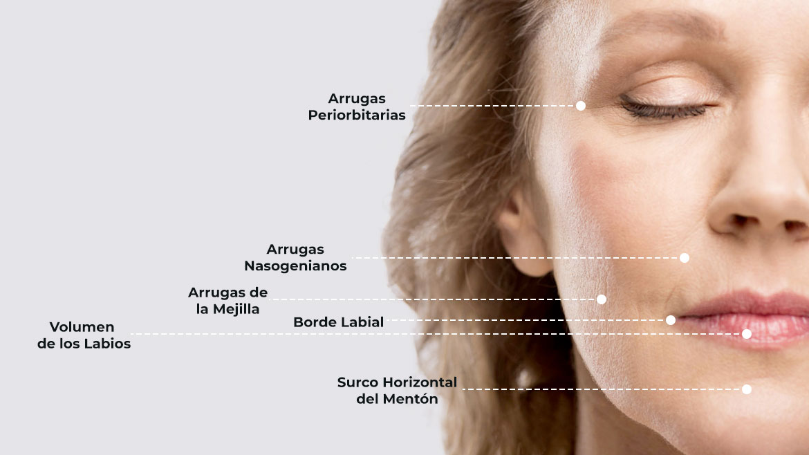 voirol-zonas-a-tratar-acido-hialuronico zonas a tratar ácido hialurónico