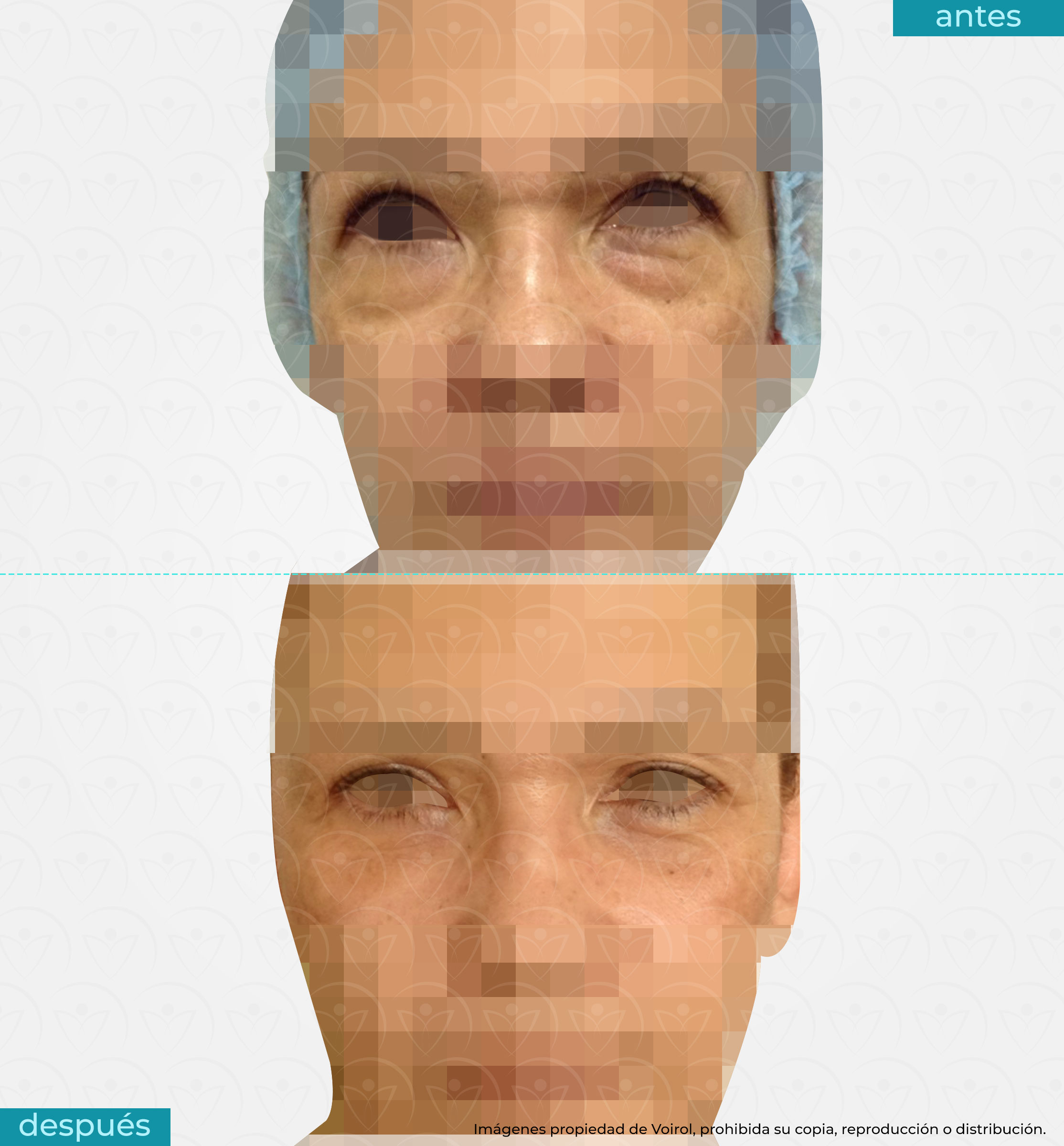 antes y después de la blefaroplastía