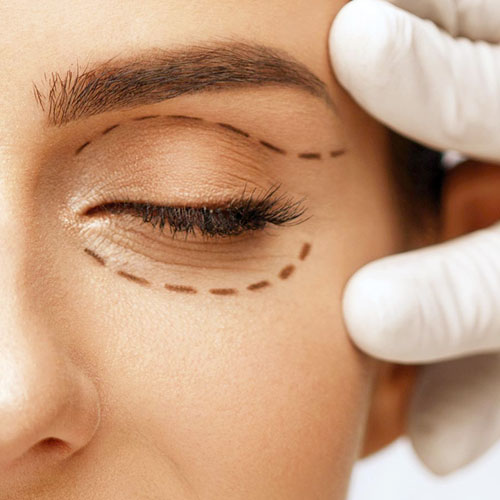 voirol-blefaroplastia-1 cirugía de párpados