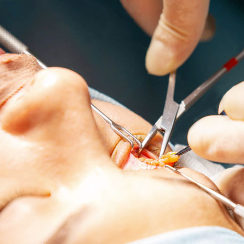 voirol-blefaroplastia-2 blefaroplastia