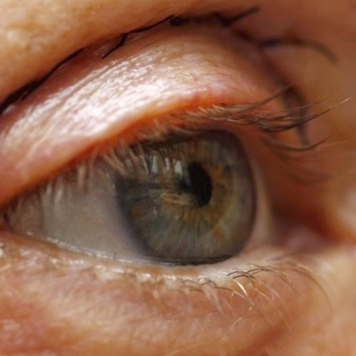voirol-blefaroplastia-3 cirugía de párpados