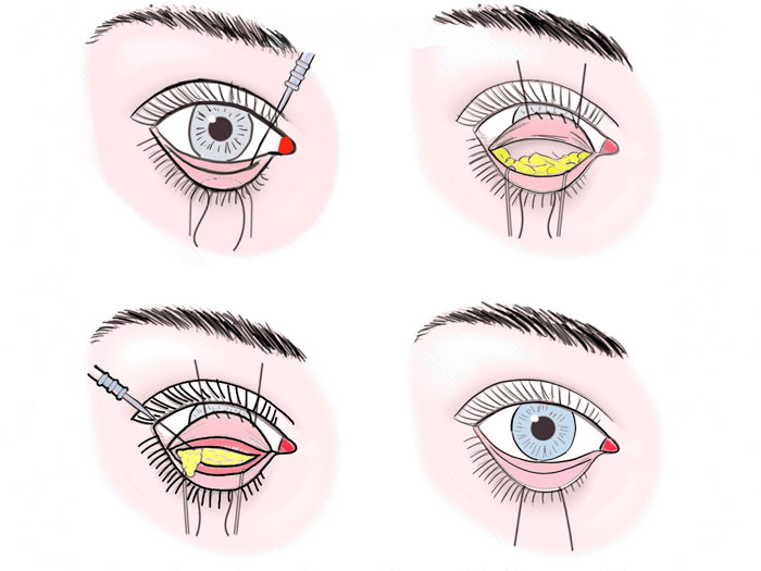 voirol-blefaroplastia-procedimiento-1 blefaroplastia párpado inferior