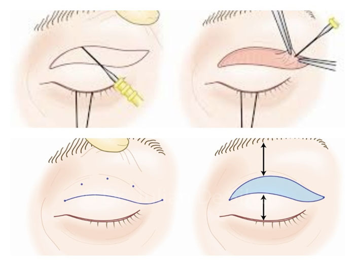 voirol-blefaroplastia-procedimiento-2 blefaroplastia párpado superior