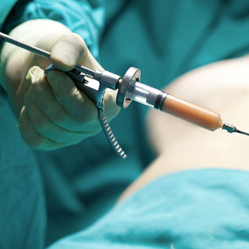 voirol-aumento-de-gluteos-2 lipoinyección de glúteos