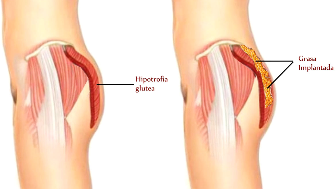 voirol-aumento-de-gluteos-procedimiento procedimiento lipoinyección de glúteos