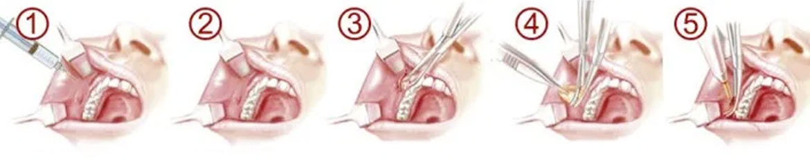 Bichectomía (Cirujía de Mejillas) - Dr. Voirol Cirugía Plástica