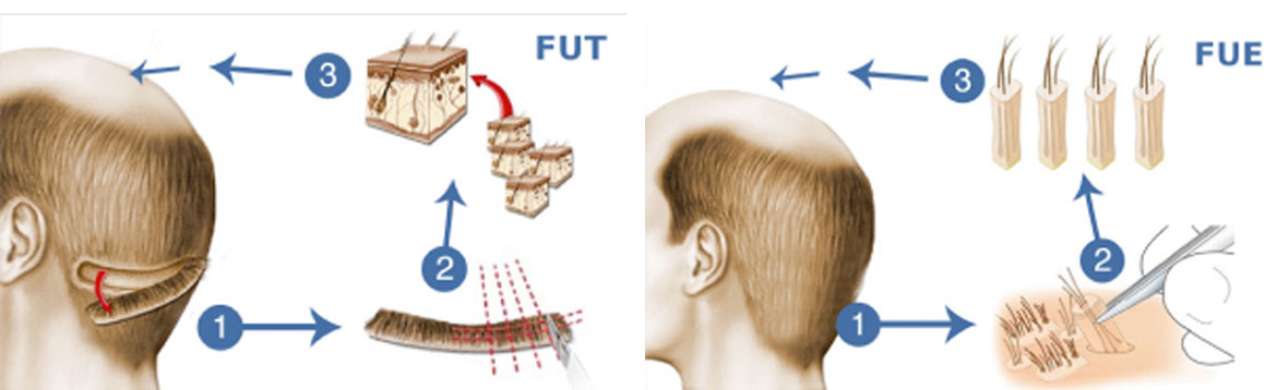 voirol-injerto-de-cabello-procedimiento injerto de cabello procedimiento
